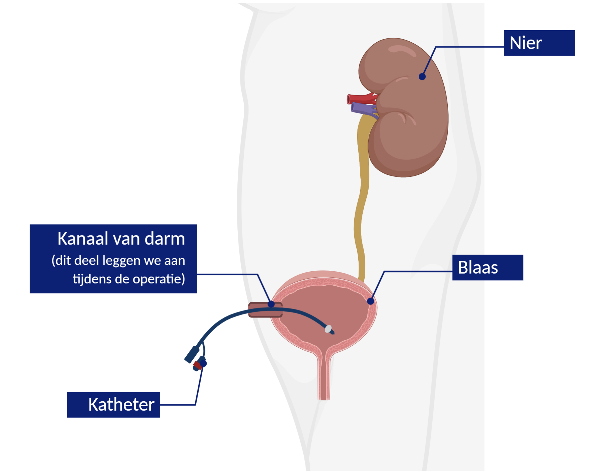 Continent urinestoma operatie, en katheteriseren